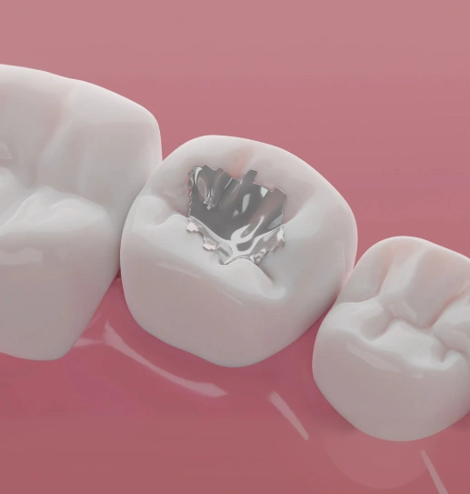 composite-fillings