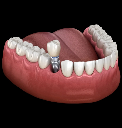 dental-implants