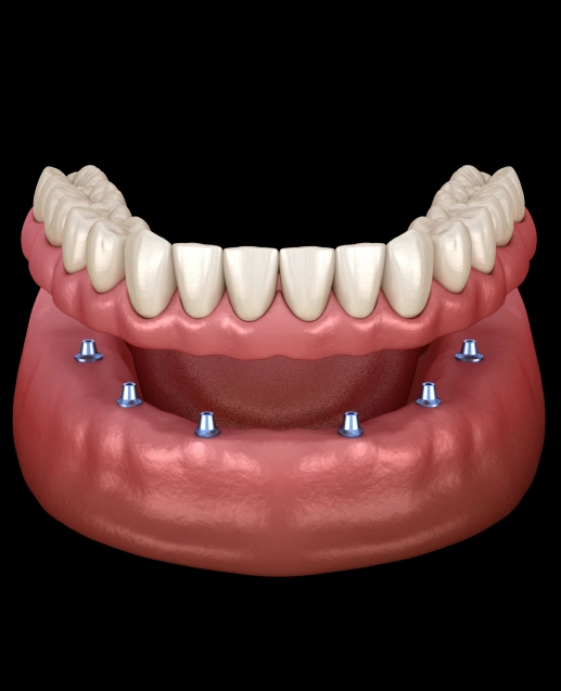implant-supported-dentures