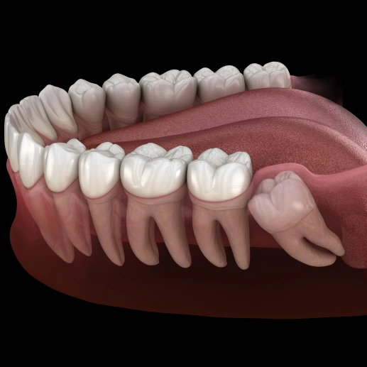 wisdom-teeth-removal