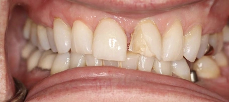 Periodontal Care in Daphne